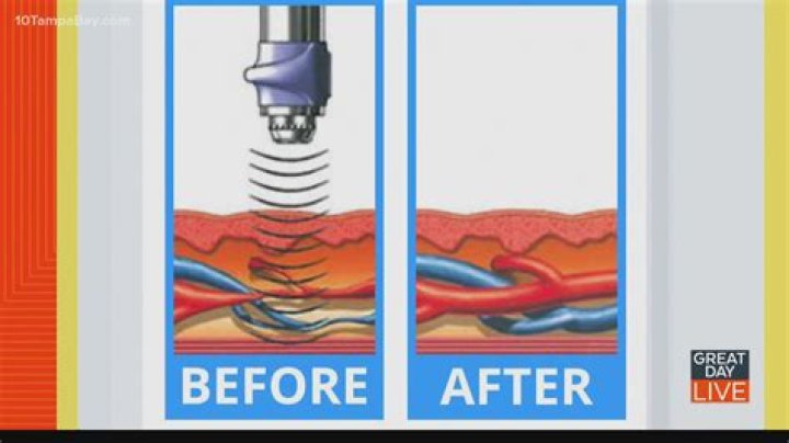 acoustic wave therapy for ed tampa