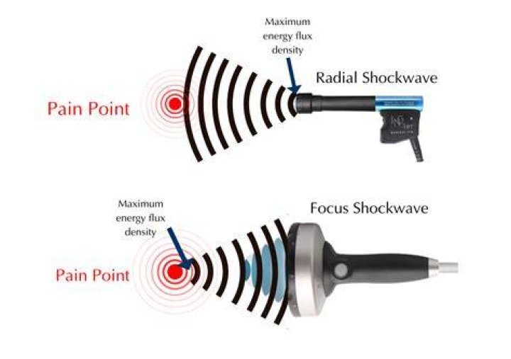 acoustic wave therapy work for ed snohomish county | Low-Intensity Extracorporeal Shock