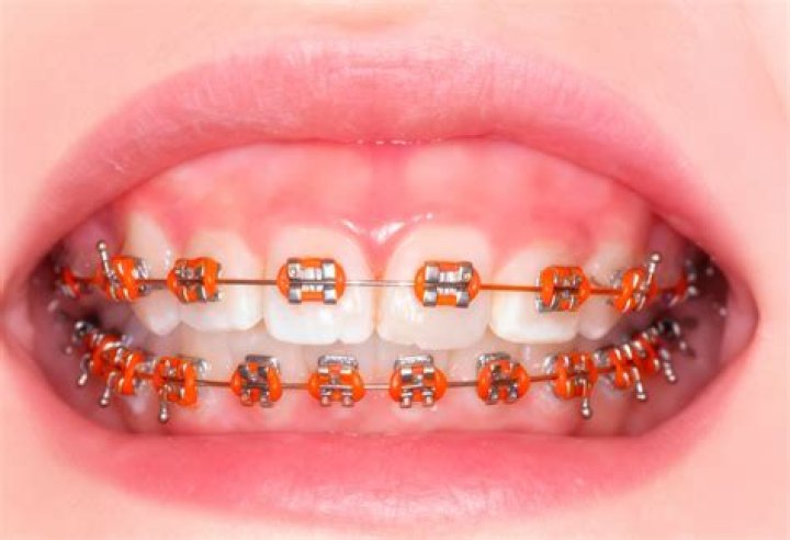 Affordable Braces East Orange - Braces Quote East Orange