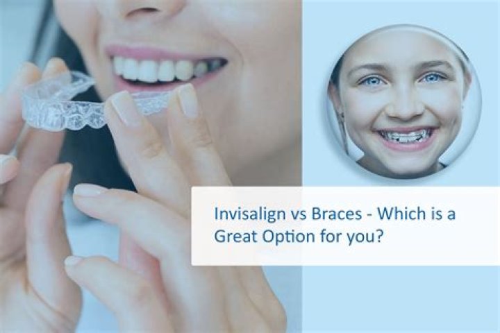 Affordable Invisalign and Braces Quotes Roseville