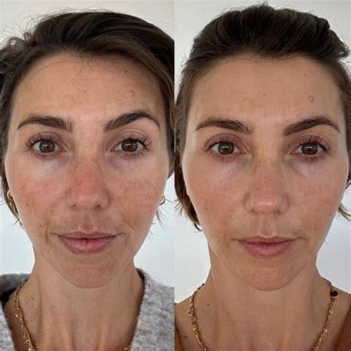 Before and After Results, Ingredients, and Side Effects..