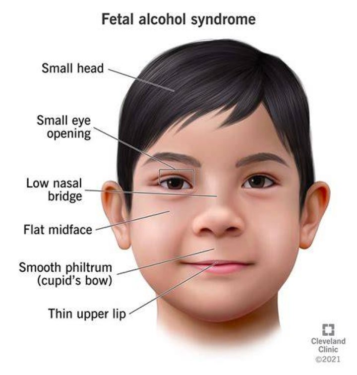 Bella Ramsey And Fetal Alcohol Syndrome