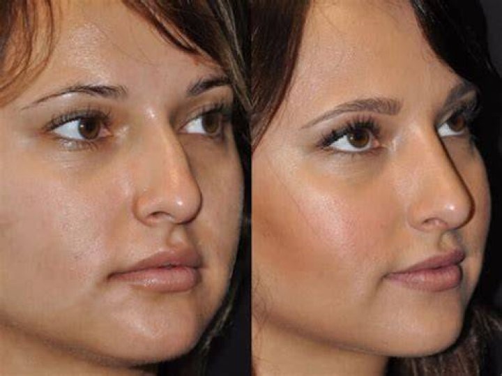 Best Rhinoplasty Santa Barbara