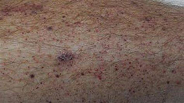 Bleeding into the skin