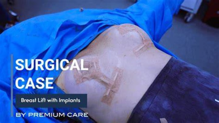 Breast Lift with Implants