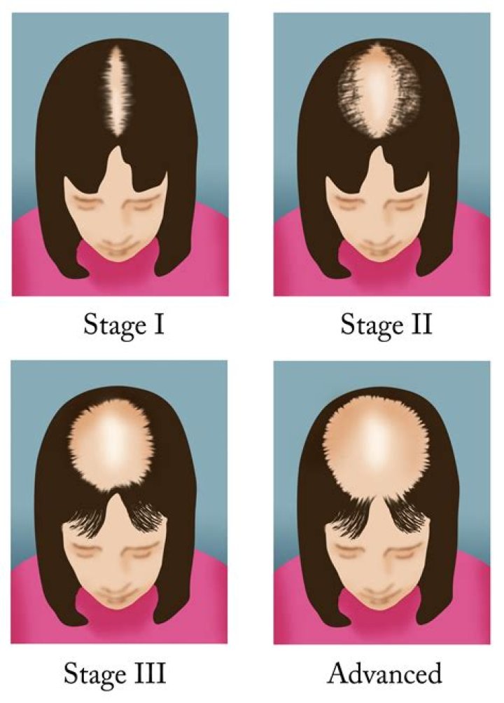 can female hair loss be treated Pearl City Boca Raton FL 33432