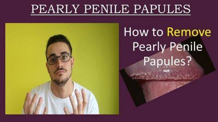 Can you Squeeze Pearly Penile Papules? Be Cautious of Scarring