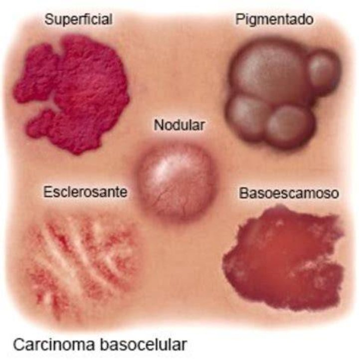 Cáncer de piel o carcinoma de célula basal en la nariz