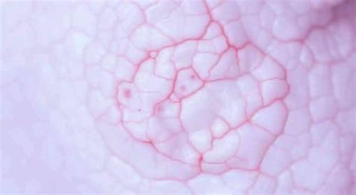 Celulitis estreptocócica perianal