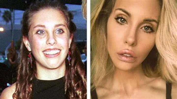 Chloe Lattanzi's Plastic Surgery Journey