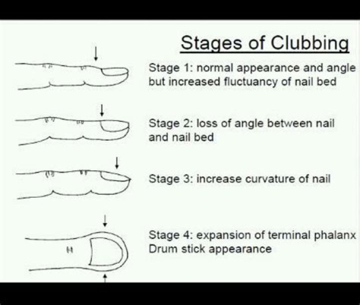 Clubbing of the fingers or toes