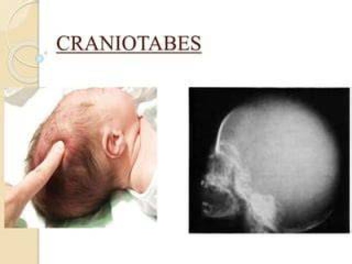 Craniotabes