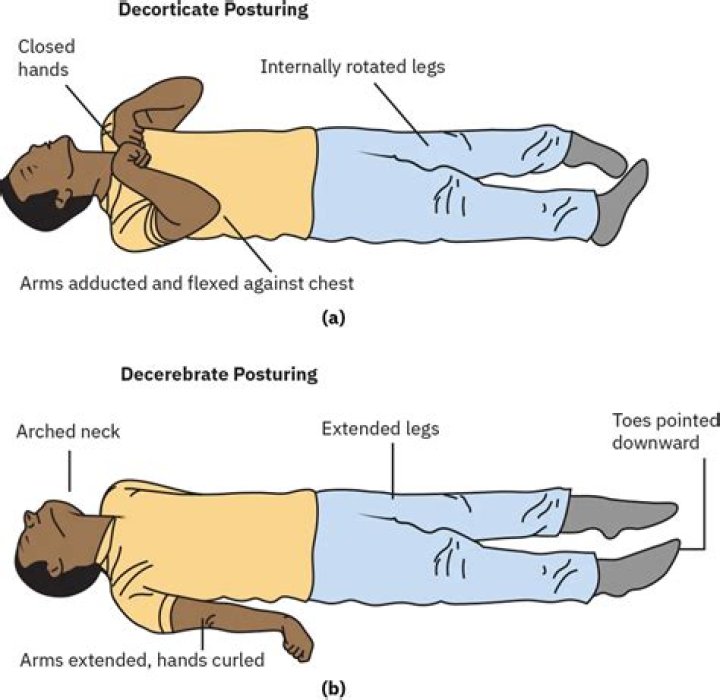 Decorticate posture