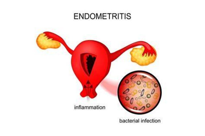 Endometritis