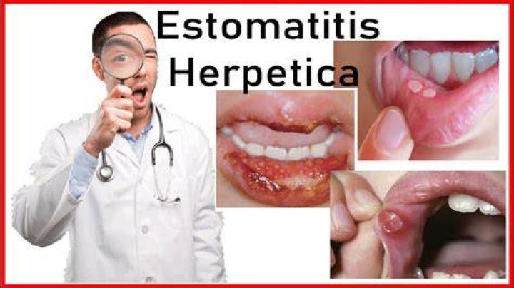 Estomatitis herpética