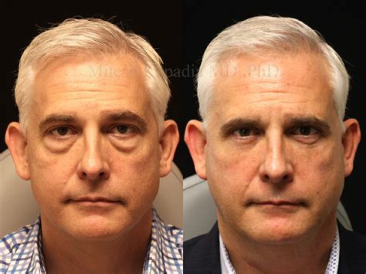 Eyelid Surgery