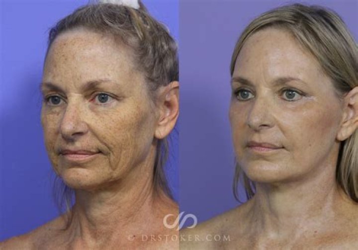 Facelift Near Me Ft Myers FL