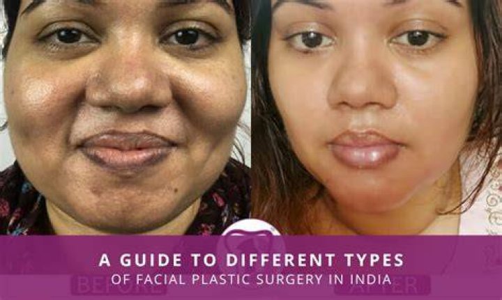 Facial Plastic Surgery in Bitter Lake Washington - Puget Sound