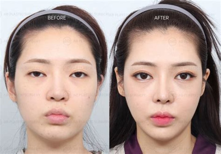 Facial Plastic Surgery in South Lake Union Washington - Puget Sound