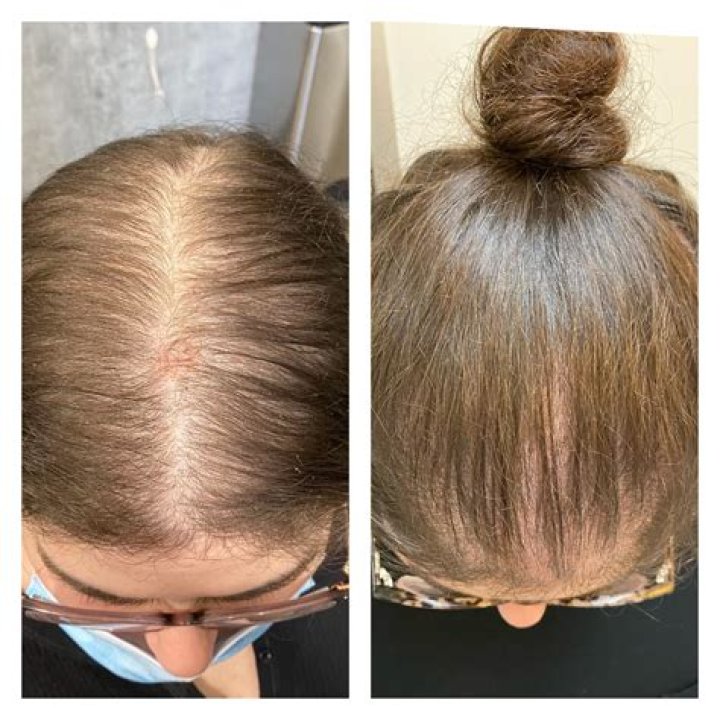 female hair loss treatment reviews Pearl City Boca Raton FL 33432