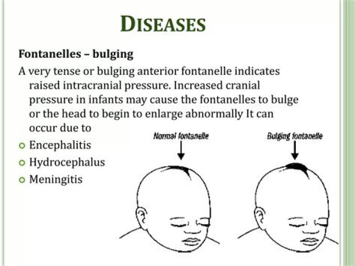 Fontanelles - bulging