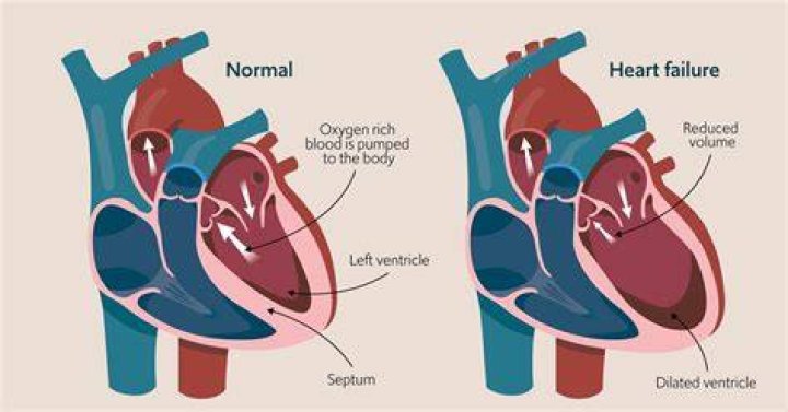 Heart Failure And The Plight Of Extreme Obesity
