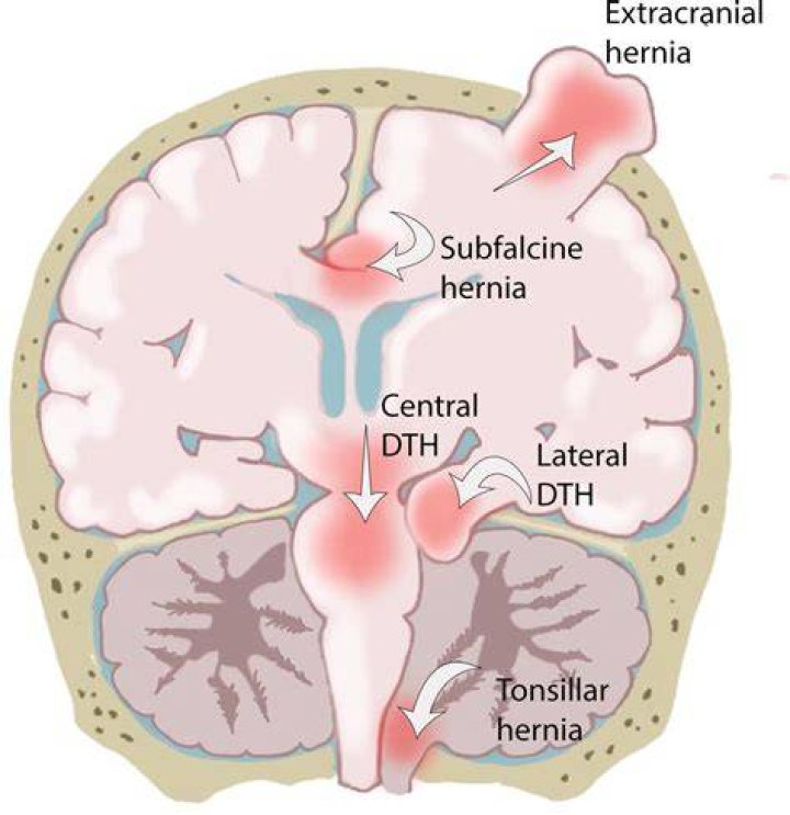 Hernia cerebral