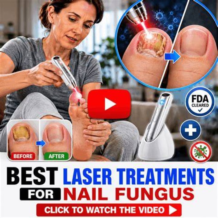 home laser treatment for nail fungus