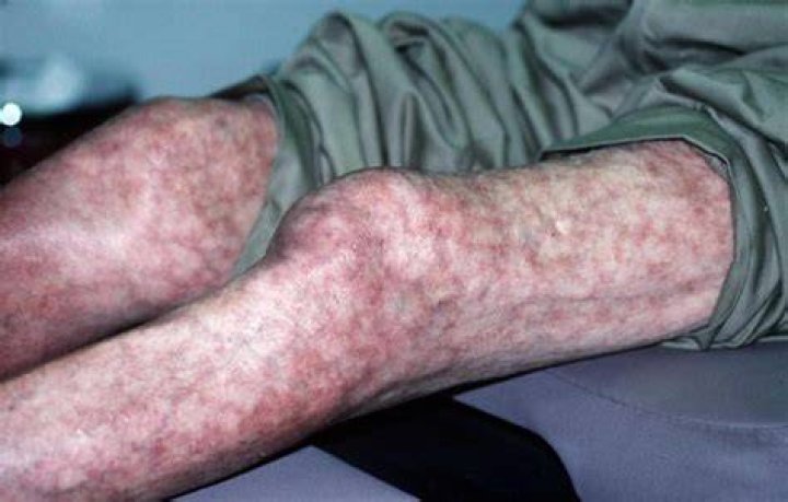 Idiopathic livedo reticularis