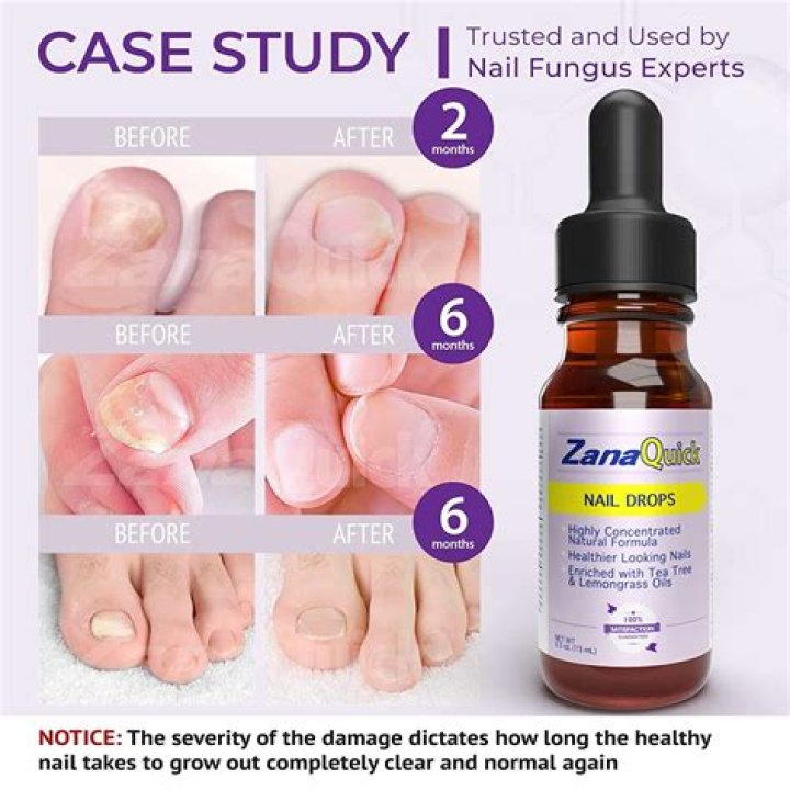 is there an over-the-counter medicine for nail fungus