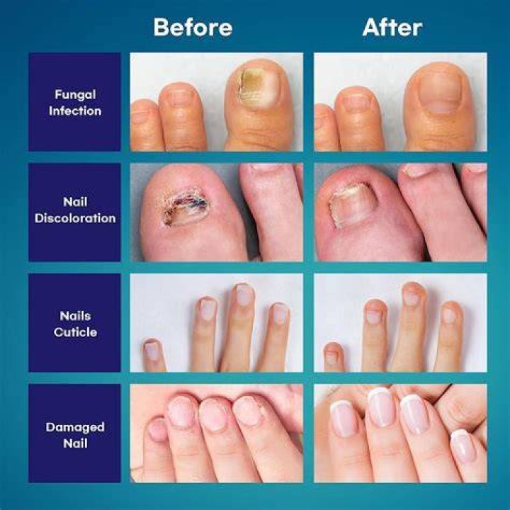 Laser Treatment Of Nail Fungus Doctor Kansas City- KC Foot Care