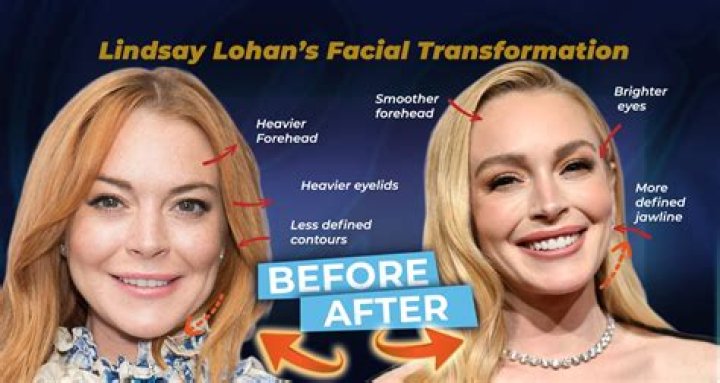 Lindsay Lohan's Plastic Surgery Journey