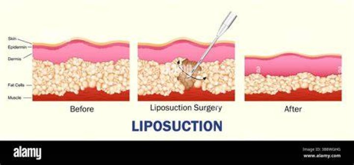 liposuction in Fremont Californian Medical Spa Receiving Favorable Reviews +1 510-744-1582
