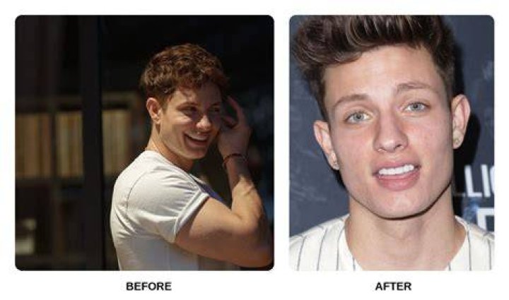 Matt Rife Before And After Teeth