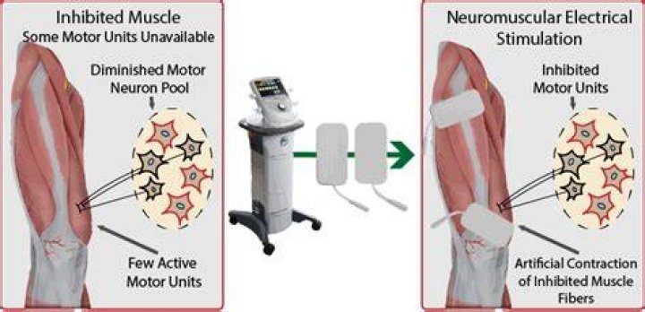 Neuromuscular Electrical Stimulation (NMES)