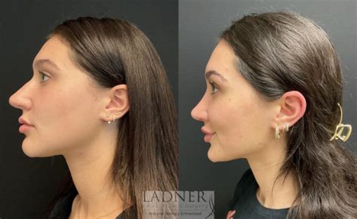 nose job