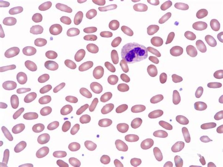 Ovalocitosis hereditaria