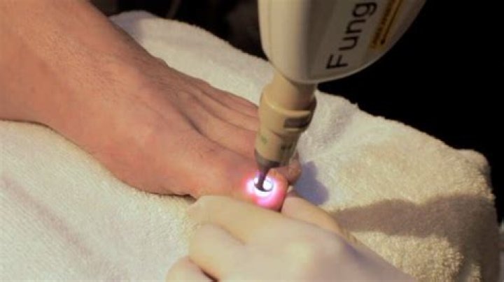 pros and cons of laser treatment for toenail fungus