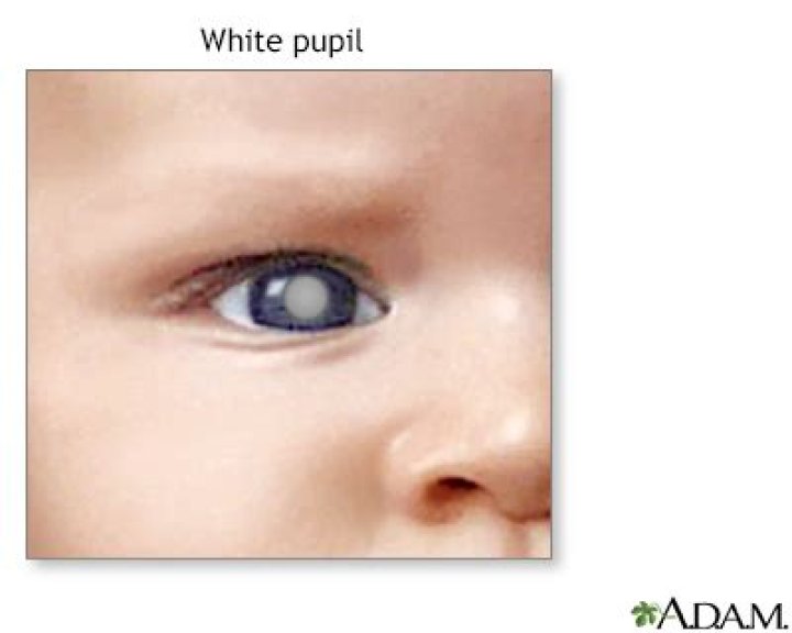 Pupil - white spots