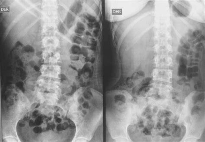 Radiografía abdominal