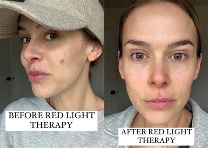 Red Light Therapy Before and After Photos Legs