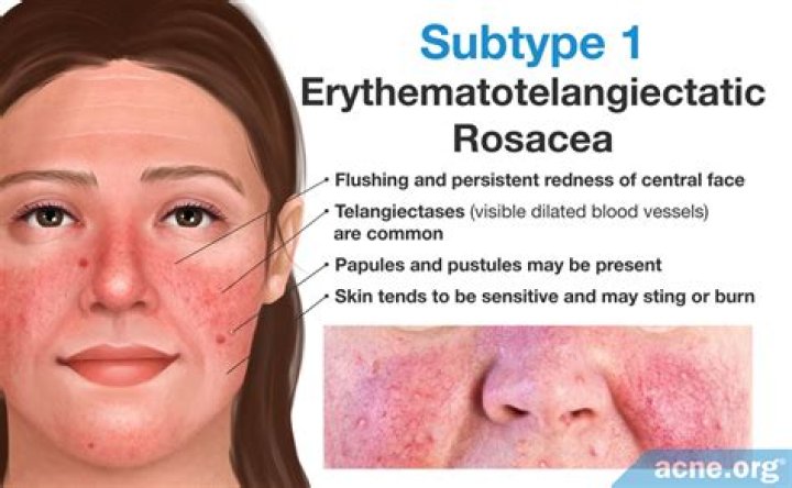 red light therapy, subtype 1 rosacea, doctor florida