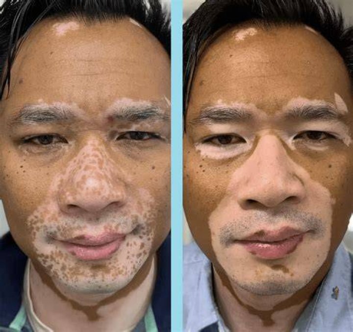 red spots on vitiligo after uvb light therapy