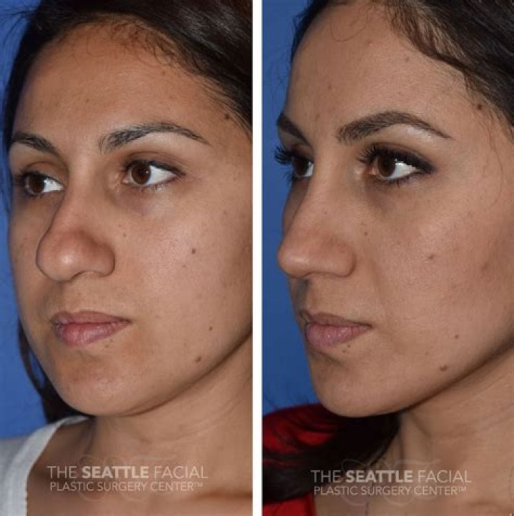 Rhinoplasty in Seattle WA - Nose Surgery Seattle Washington