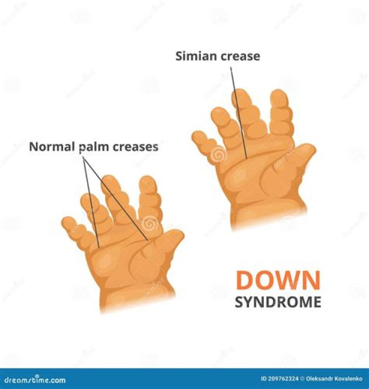 Simian crease