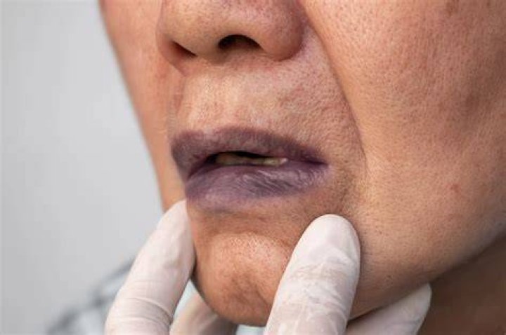 Skin discoloration - bluish