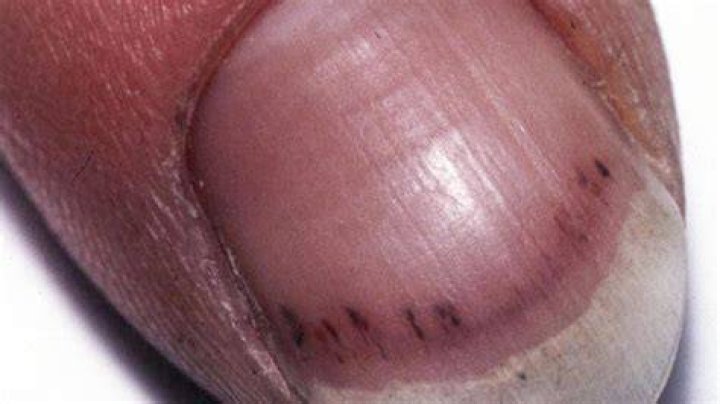 Splinter hemorrhages