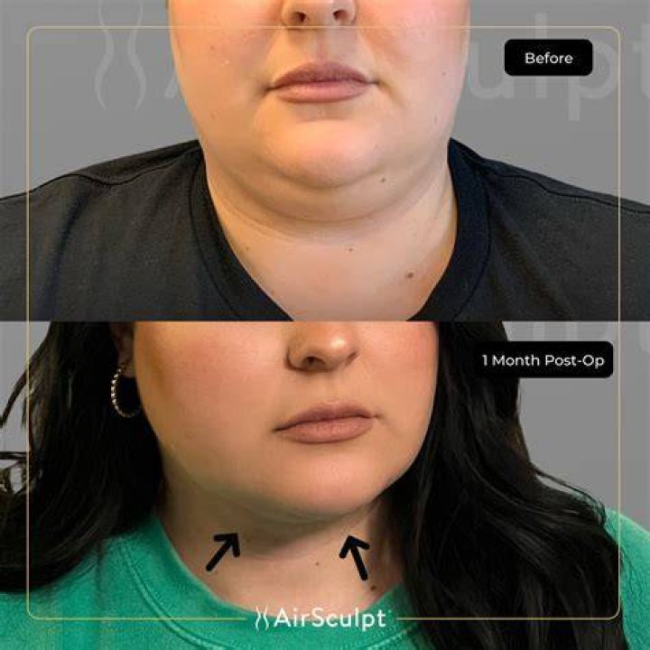 Tacoma Chin Liposuction Experts