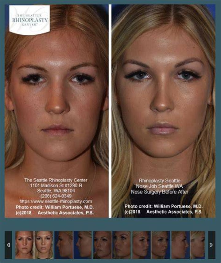 The Seattle Rhinoplasty Center