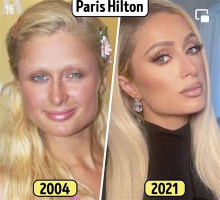 The Truth Behind Paris Hilton's Nose: Has She Had Surgery?